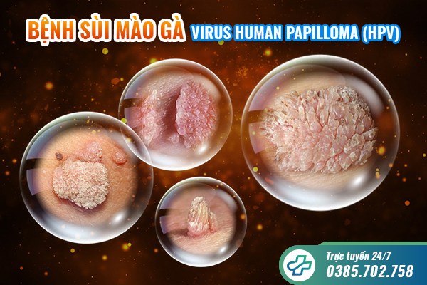 Dấu hiệu, triệu chứng của bệnh sùi mào gà