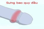Sưng bao quy đầu là bệnh gì? Phương pháp điều trị hiệu quả