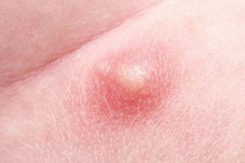 Cậu nhỏ nổi mụn trắng ngứa: Nguyên nhân và cách giải quyết