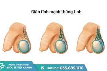 [GIÃN TĨNH MẠCH TINH HOÀN] Căn bệnh âm thầm khiến nam giới vô sinh – Đừng xem thường!