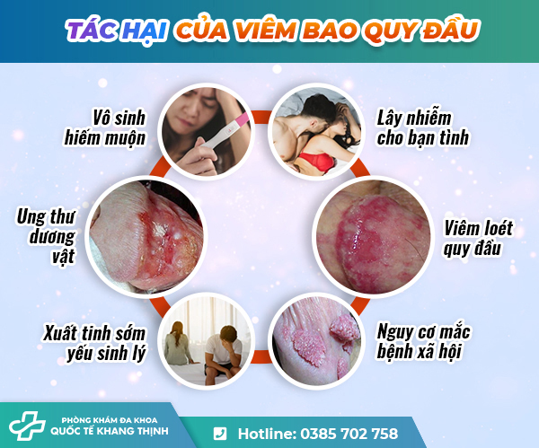 [ Chuyên gia y tế chia sẻ] Viêm bao quy đầu gây nên những tác hại gì?