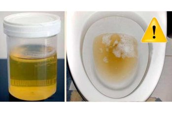 Tiểu buốt có mủ ở nam giới là bệnh gì?