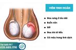 Khám viêm tinh hoàn là khám những gì?