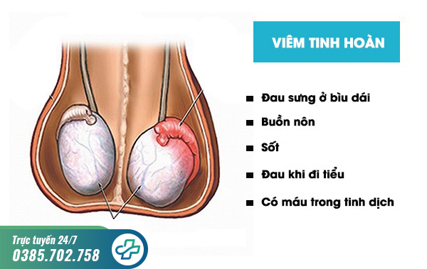 Viêm tinh hoàn có chữa được không? Gợi ý giải pháp hiệu quả và an toàn cho nam giới
