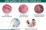 Nấm dương vật: Gây ung thư nếu không điều trị kịp thời