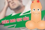 Viêm bao quy đầu: Dấu hiệu, nguyên nhân và cách điều trị hiệu quả