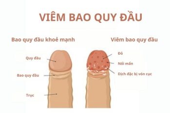 [Tìm hiểu] Viêm bao quy đầu là bệnh gì, có nguy hiểm không?
