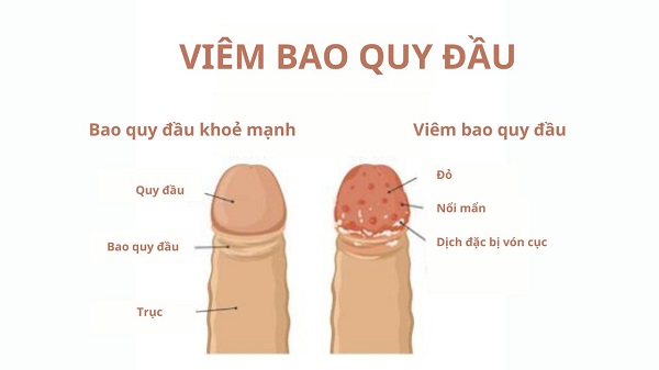 [Tìm hiểu] Viêm bao quy đầu là bệnh gì, có nguy hiểm không?