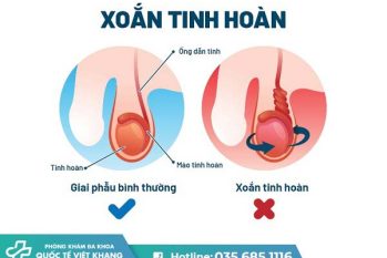 Xoắn tinh hoàn là gì? Dấu hiệu cảnh báo và mức độ nguy hiểm cần biết