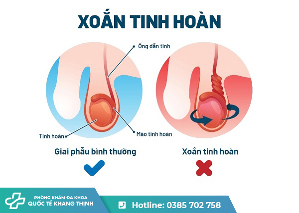 Xoắn tinh hoàn là gì? Dấu hiệu cảnh báo và mức độ nguy hiểm cần biết