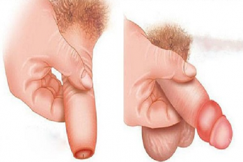 Da bao quy đầu bị sưng phồng: Nguyên nhân và cách khắc phục