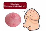 Nổi mẩn bao quy đầu: Nguyên nhân và cách điều trị
