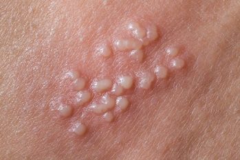 Nổi mụn li ti ở dương vật là bệnh gì? Cách điều trị hiệu quả