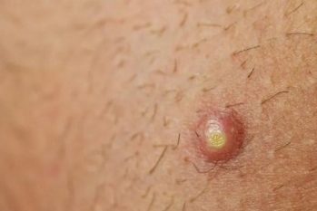 Bao quy đầu nổi mẩn là bệnh gì? Cách điều trị an toàn