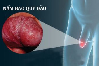 Những biểu hiện của nấm bao quy đầu và cách điều trị hiệu quả