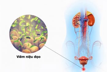 Tổng quan viêm niệu đạo ở nam giới: Nguyên nhân, dấu hiệu, cách chữa