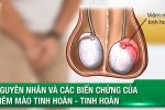 Viêm mào tinh hoàn: Nguyên nhân, triệu chứng và cách điều trị