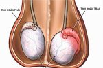 Đau tức tinh hoàn trái: Nguyên nhân và cách điều trị an toàn