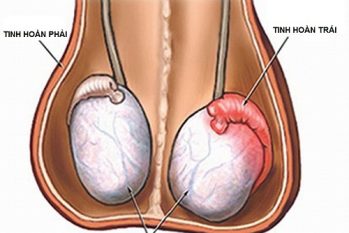 Đau tức tinh hoàn trái: Nguyên nhân và cách điều trị an toàn