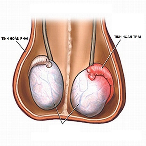 Đau tức tinh hoàn trái: Nguyên nhân và cách điều trị an toàn