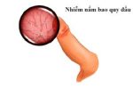 Nấm vùng kín nam: Nguyên nhân và cách điều trị hiệu quả