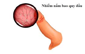 Nấm vùng kín nam: Nguyên nhân và cách điều trị hiệu quả