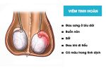Viêm tinh hoàn: Nguyên nhân, dấu hiệu và cách điều trị hiệu quả
