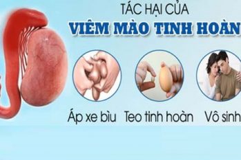 Viêm mào tinh hoàn: Nhận biết sớm – Xử lý đúng để tránh vô sinh