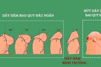 [Chia sẻ] Những điều cần biết khi bị đứt dây hãm bao quy đầu