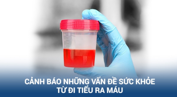 Phòng Khám Đa Khoa Quốc Tế Khang Thịnh – Điều trị khỏi bệnh tiểu ra máu bằng hệ thống CRS
