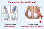 Tinh hoàn bên to bên nhỏ: Nguyên nhân, ảnh hưởng và cách xử lý