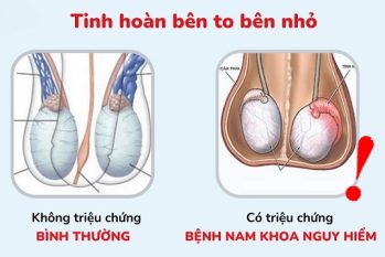 Tinh hoàn bên to bên nhỏ: Nguyên nhân, ảnh hưởng và cách xử lý