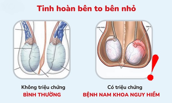Tinh hoàn bên to bên nhỏ: Nguyên nhân, ảnh hưởng và cách xử lý
