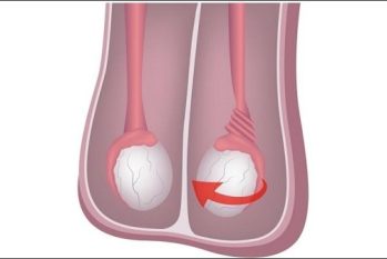 Teo tinh hoàn có chữa được không? Giải đáp thắc mắc và phương pháp điều trị