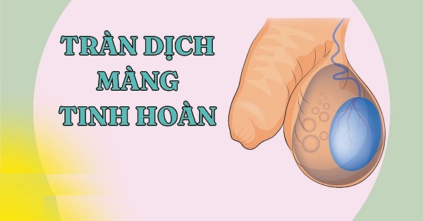 Tràn dịch tinh hoàn: Nguyên nhân, triệu chứng và chi phí điều trị hiện nay