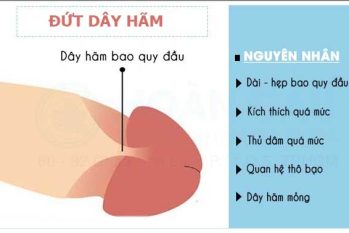 Những sai lầm thường gặp khi xử lý vấn đề dây hãm bao quy đầu và lời khuyên chuyên gia