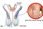 [BỆNH GIÃN TĨNH MẠCH TINH HOÀN] Có chữa được không? Bao lâu thì khỏi? Bác sĩ trả lời!