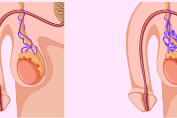 [CẨN TRỌNG] Giãn tĩnh mạch tinh hoàn – Dễ nhầm với bệnh khác, phát hiện sớm để tránh vô sinh!