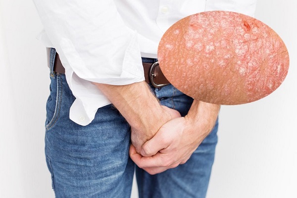Dái bị ngứa, nổi mụn: Nguyên nhân và cách điều trị hiệu quả tại PK Khang Thịnh