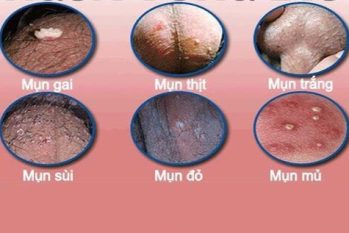 Mọc Mụn Ở Tinh Hoàn – Cảnh Báo Bệnh Lý Nguy Hiểm Nam Giới Không Được Bỏ Qua