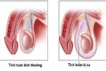 Triệu chứng sa tinh hoàn và những hiểu lầm khiến nam giới chủ quan