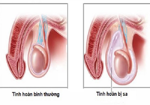 Triệu chứng sa tinh hoàn và những hiểu lầm khiến nam giới chủ quan