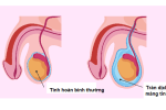 Tràn dịch màng tinh hoàn là gì? Có nguy hiểm không? Điều trị thế nào cho hiệu quả và an toàn?