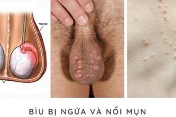 Tinh hoàn nổi cục, mọc mụn, cứng bất thường: Dấu hiệu cảnh báo bệnh lý nam khoa nguy hiểm