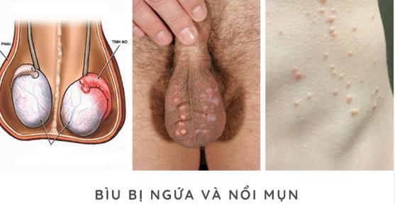 Tinh hoàn nổi cục, mọc mụn, cứng bất thường: Dấu hiệu cảnh báo bệnh lý nam khoa nguy hiểm