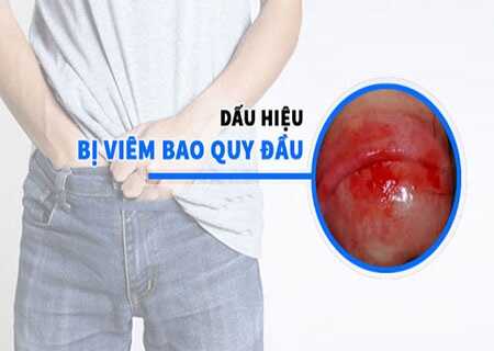 Viêm bao quy đầu có mủ, loét, sưng đỏ? Nhận giải pháp từ chuyên gia!