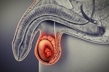 Cách chữa u tinh hoàn: Các phương pháp điều trị hiện đại nhất