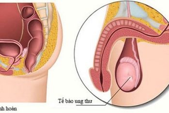 Ung thư tinh hoàn có nguy hiểm không? Biến chứng và ảnh hưởng đến sức khỏe nam giới