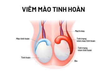 Mào Tinh Hoàn Sưng: Hiểu Rõ Triệu Chứng Và Phương Pháp Hỗ Trợ Điều Trị