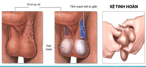 [GIẢI MÃ] Tinh hoàn bị xệ: Bình thường hay báo động bệnh lý nam khoa